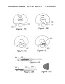 METHODS AND APPARATUS FOR TREATING DISC HERNIATION AND PREVENTING THE     EXTRUSION OF INTERBODY BONE GRAFT diagram and image