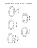METHODS AND APPARATUS FOR TREATING DISC HERNIATION AND PREVENTING THE     EXTRUSION OF INTERBODY BONE GRAFT diagram and image