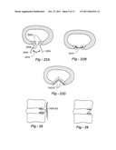 METHODS AND APPARATUS FOR TREATING DISC HERNIATION AND PREVENTING THE     EXTRUSION OF INTERBODY BONE GRAFT diagram and image