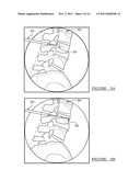 System and Method for Placing and Determining an Appropriately Sized     Surgical Implant diagram and image