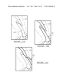 System and Method for Placing and Determining an Appropriately Sized     Surgical Implant diagram and image