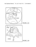 System and Method for Placing and Determining an Appropriately Sized     Surgical Implant diagram and image