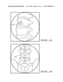 System and Method for Placing and Determining an Appropriately Sized     Surgical Implant diagram and image