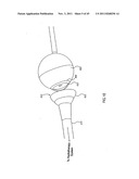 ORTHOVOLTAGE RADIOTHERAPY diagram and image