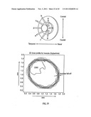 ORTHOVOLTAGE RADIOTHERAPY diagram and image