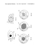 ORTHOVOLTAGE RADIOTHERAPY diagram and image