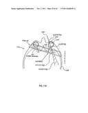 ORTHOVOLTAGE RADIOTHERAPY diagram and image