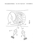 ORTHOVOLTAGE RADIOTHERAPY diagram and image