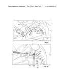 Method For Pre-Operative Visualization Of Instrumentation Used With A     Surgical Guide For Dental Implant Placement diagram and image