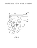 METHOD AND APPARATUS FOR DETECTING AND DISCRIMINATING TACHYCARDIA diagram and image