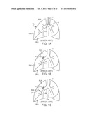 MINIMALLY INVASIVE DETERMINATION OF COLLATERAL VENTILATION IN LUNGS diagram and image