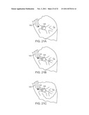 MINIMALLY INVASIVE DETERMINATION OF COLLATERAL VENTILATION IN LUNGS diagram and image