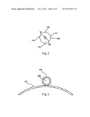 Device for Treating Hardened Lesions diagram and image