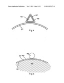 Device for Treating Hardened Lesions diagram and image