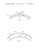 Device for Treating Hardened Lesions diagram and image