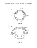 PRECISION ABLATING METHOD diagram and image