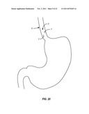 PRECISION ABLATING METHOD diagram and image