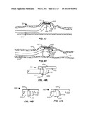 PRECISION ABLATING METHOD diagram and image