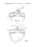 TOURNIQUET SYSTEM diagram and image