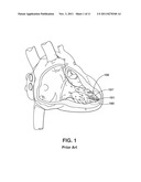 Two-Stage Delivery Systems and Methods for Fixing a Leadless Implant to     Tissue diagram and image