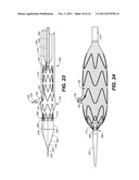 Mobile External Coupling with Internal Sealing Cuff for Branch Vessel     Connection diagram and image