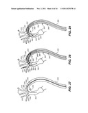 Mobile External Coupling with Internal Sealing Cuff for Branch Vessel     Connection diagram and image