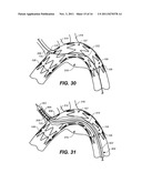 Mobile External Coupling with Internal Sealing Cuff for Branch Vessel     Connection diagram and image