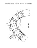 Mobile External Coupling with Internal Sealing Cuff for Branch Vessel     Connection diagram and image