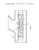 STENT WITH SELF-DEPLOYABLE PORTION HAVING WINGS OF DIFFERENT LENGTHS diagram and image