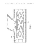 STENT WITH SELF-DEPLOYABLE PORTION HAVING WINGS OF DIFFERENT LENGTHS diagram and image