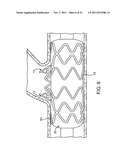 STENT WITH SELF-DEPLOYABLE PORTION HAVING WINGS OF DIFFERENT LENGTHS diagram and image