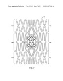 STENT WITH SELF-DEPLOYABLE PORTION HAVING WINGS OF DIFFERENT LENGTHS diagram and image