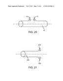 STENT WITH SELF-DEPLOYABLE PORTION HAVING WINGS OF DIFFERENT LENGTHS diagram and image