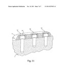 METHOD AND DEVICE FOR PLACING DENTAL IMPLANTS diagram and image