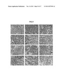 METHODS AND COMPOSITIONS FOR THE DIAGNOSIS AND TREATMENT OF EPITHELIAL     CANCERS diagram and image