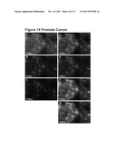 METHODS AND COMPOSITIONS FOR THE DIAGNOSIS AND TREATMENT OF EPITHELIAL     CANCERS diagram and image