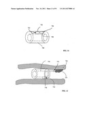 Lumen-traveling biological interface device and method of use diagram and image