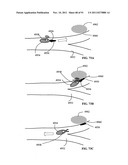 Lumen-traveling biological interface device and method of use diagram and image