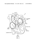 VALVE FOR VENTRICULAR ASSIST DEVICE diagram and image
