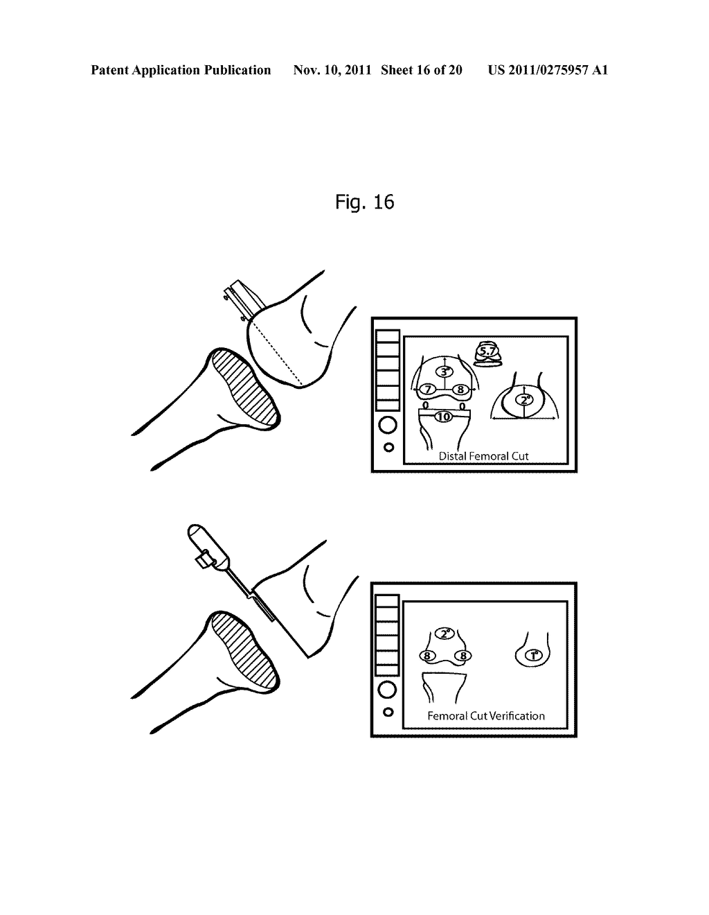 Inertial Sensor Based Surgical Navigation System for Knee Replacement     Surgery - diagram, schematic, and image 17