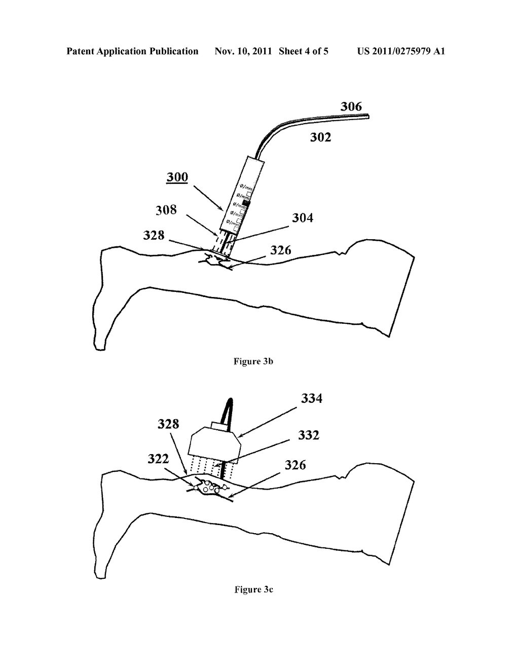 METHOD/DEVICE FOR TRANSDERMAL VASCULAR TREATMENT - diagram, schematic, and image 05