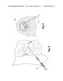 Therapeutic Delivery Device diagram and image