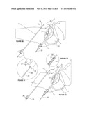 Cystotomy Catheter Capture Device diagram and image