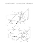 Cystotomy Catheter Capture Device diagram and image