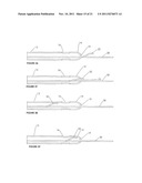 Cystotomy Catheter Capture Device diagram and image