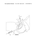 Cystotomy Catheter Capture Device diagram and image