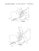 Cystotomy Catheter Capture Device diagram and image