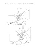 Cystotomy Catheter Capture Device diagram and image