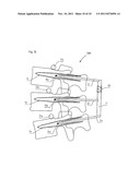 FIXATION ASSEMBLY FOR SPINAL VERTEBRAE diagram and image