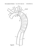 APPARATUS FOR CURVING AN IMPLANTABLE MEDICAL DEVICE IN A LUMEN diagram and image